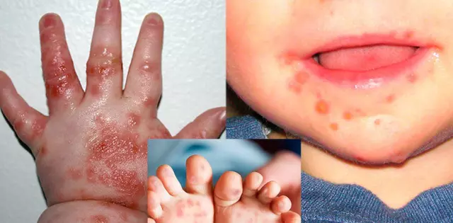 Biểu hiện trên da điển hình của bệnh tay chân miệng ở trẻ