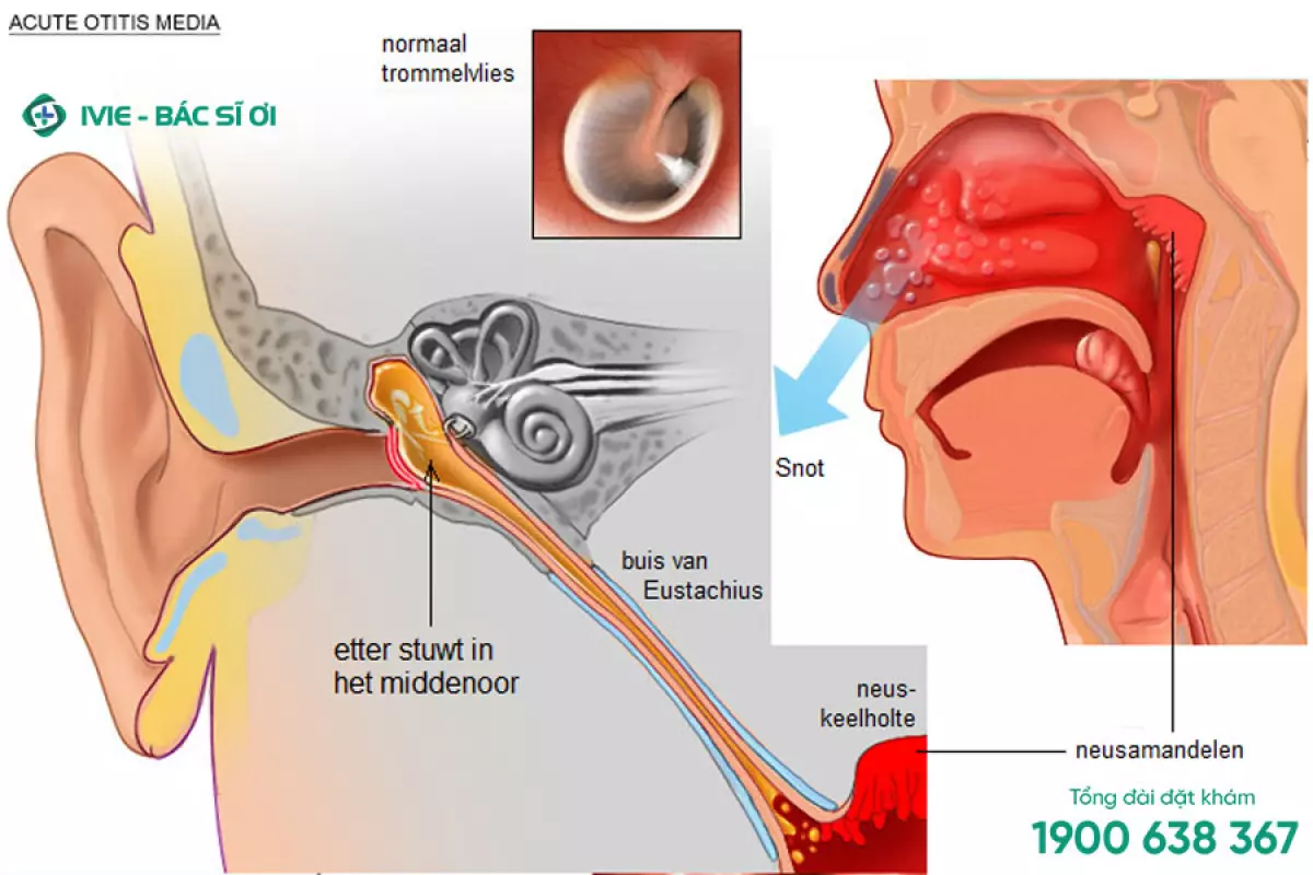 Viêm tai giữa là tình trạng viêm nằm ở tai giữa
