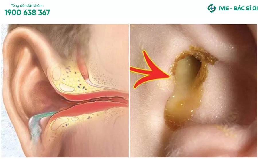Chảy dịch, mủ vàng bất thường là một trong những dấu hiệu viêm tai giữa