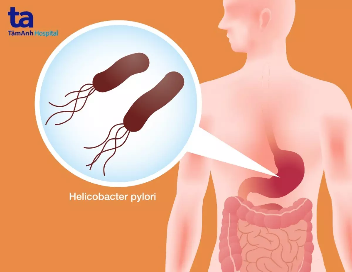 Minh họa hình ảnh vi khuẩn H.p trong dạ dày người bệnh.