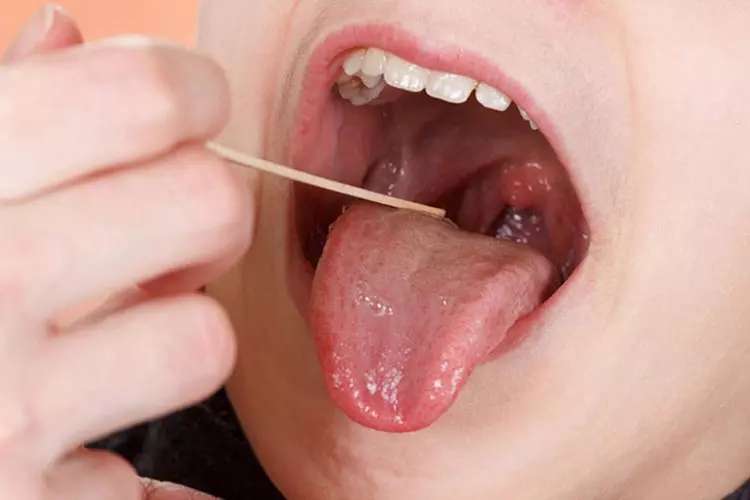 Phương pháp phết dịch cổ họng nuôi cấy vi khuẩn