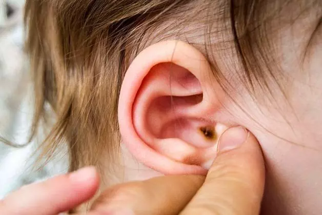 Người bị nhiễm trùng tai sẽ có dấu hiệu chảy dịch