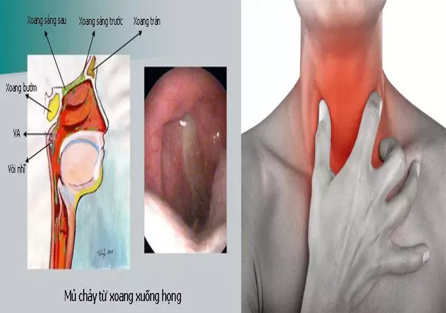 Đau họng, ho - Biểu hiện của bệnh viêm họng