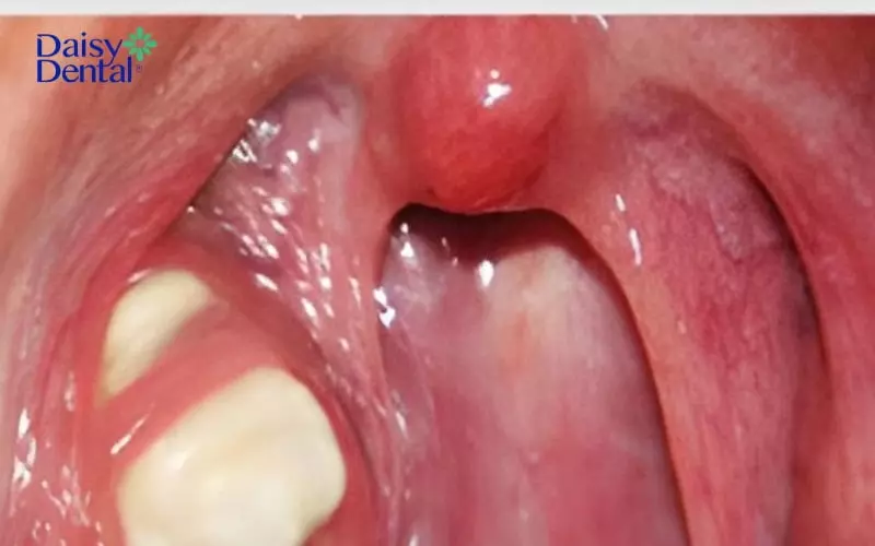 Hình ảnh lưỡi gà bị sưng viêm thường gặp kèm với bệnh lý khác trong khoang miệng