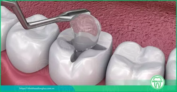 Chăm sóc răng miệng sau khi trám răng như thế nào