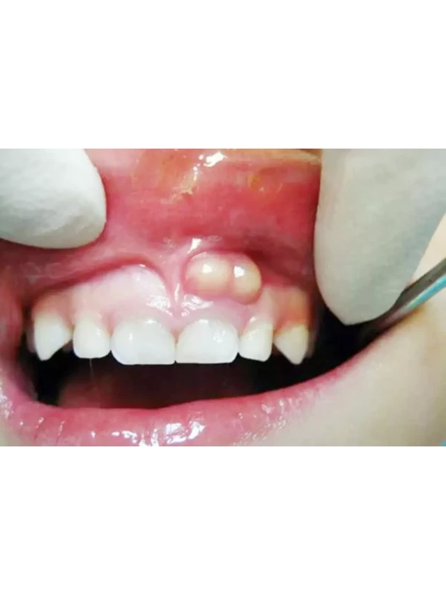   Bạn biết gì về nang chân răng?
