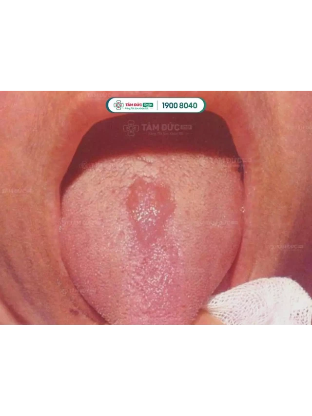   Viêm lưỡi nổi hạt: Hiểu rõ bệnh, cách điều trị và phòng ngừa